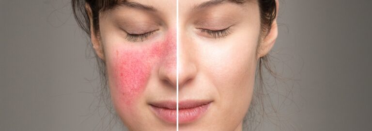 Rosacea: Mehr als nur Rötungen im Gesicht